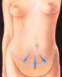 abdominplasty1