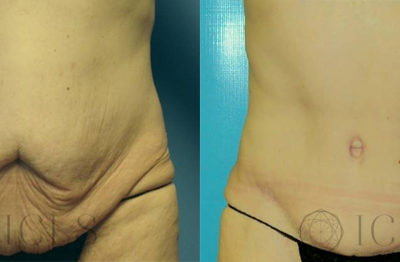 Full Abdominoplasty with Flank Liposuction