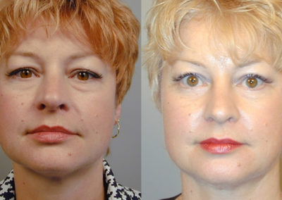 Blepharoplasty