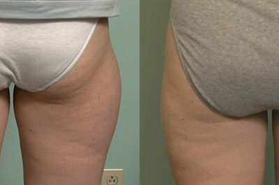 Liposuction